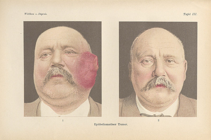 The illustration is taken from a digital copy entitled ‘Radium therapy’ from 1911 by the authors Wickham and Degrais. It shows a patient with an epitheliomatous tumour before and after radium therapy.